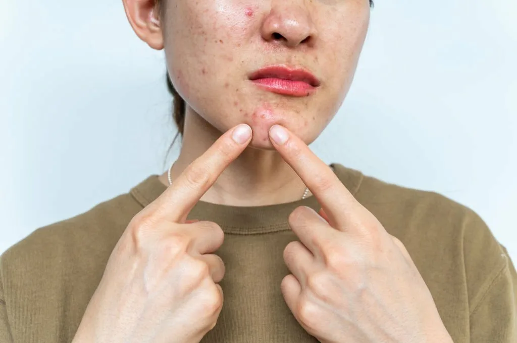 does-collagen-help-with-acne